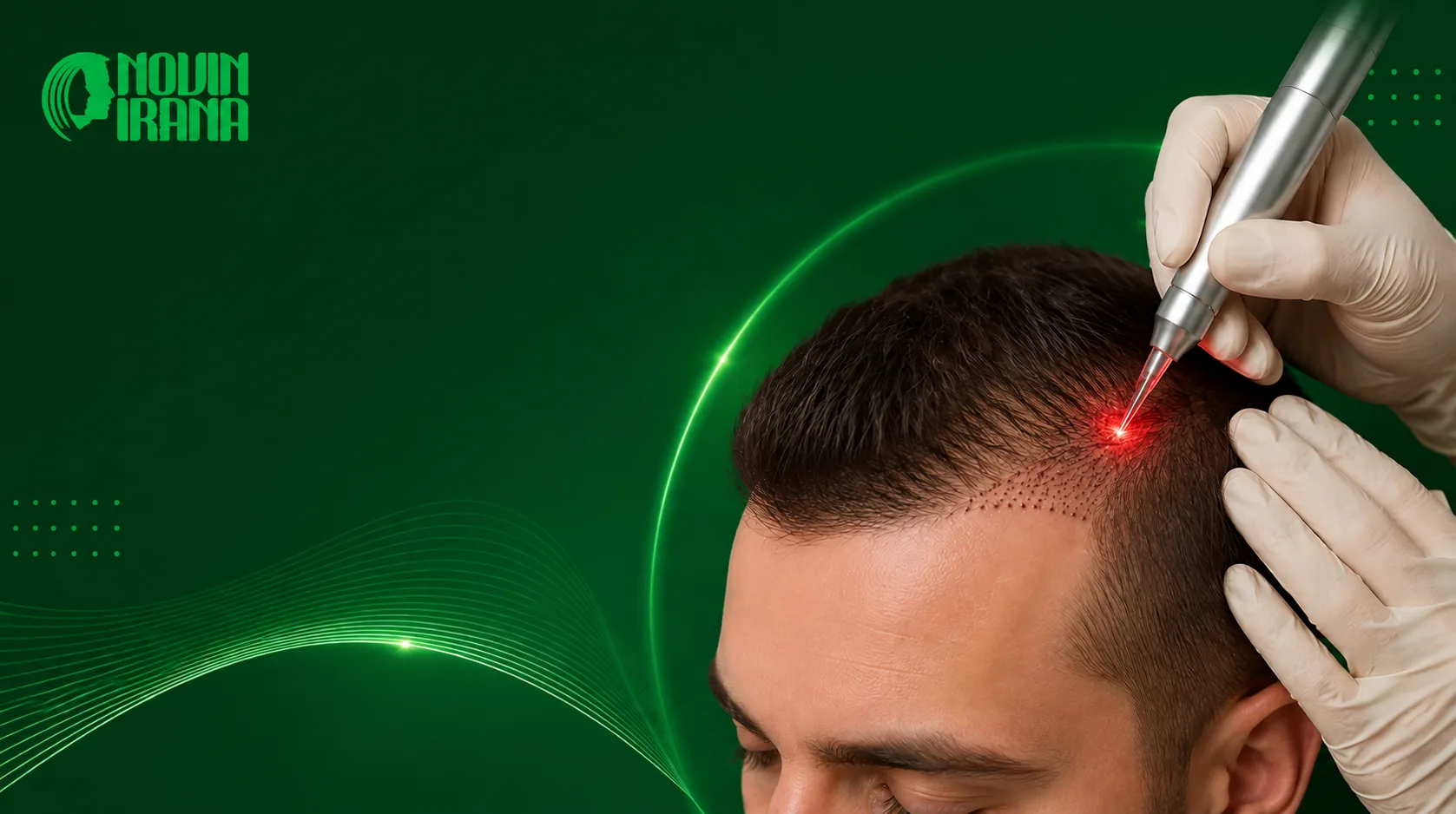 فوائد زراعة الشعر بالليزر